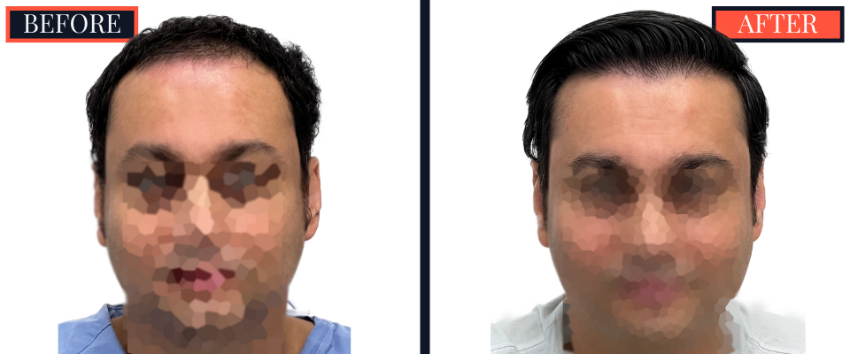 2344 GRAFT FUE BEFORE AND AFTER RESULTS