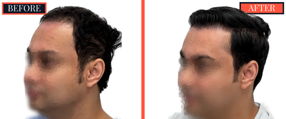 2344 GRAFT FUE BEFORE AND AFTER RESULTS