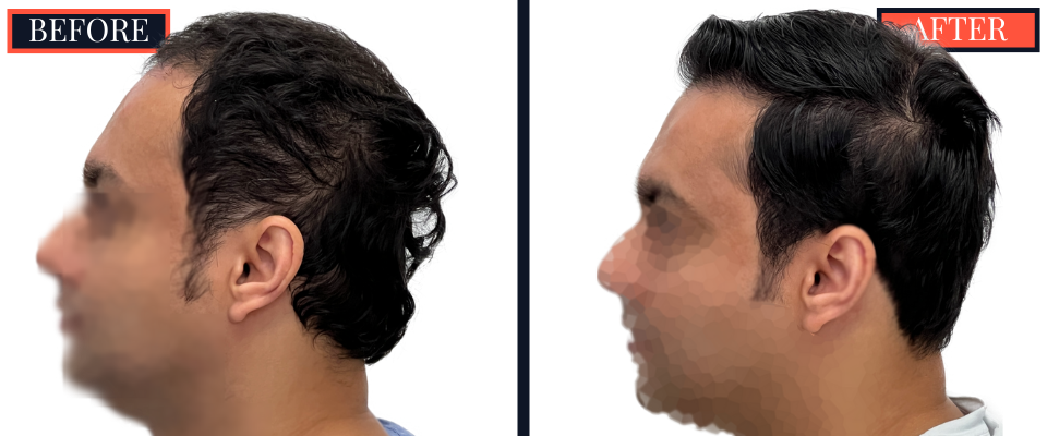 2344 GRAFT FUE BEFORE AND AFTER RESULTS