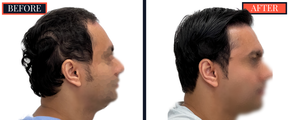 2344 GRAFT FUE BEFORE AND AFTER RESULTS
