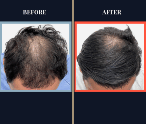 2344 GRAFT FUE BEFORE AND AFTER RESULTS