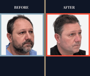 2886 GRAFT FUT HAIR TRANSPLANT RESULT