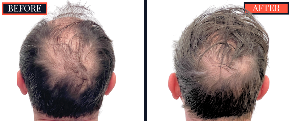 2886 GRAFT FUT HAIR TRANSPLANT RESULT