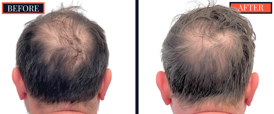 2886 GRAFT FUT HAIR TRANSPLANT RESULT