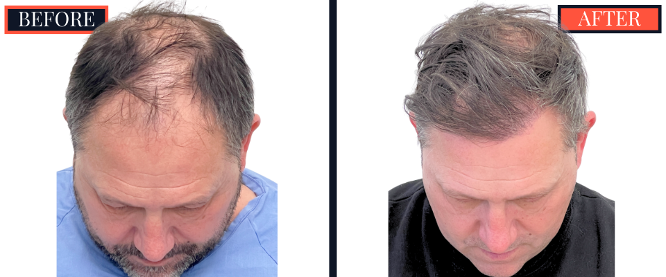 2886 GRAFT FUT HAIR TRANSPLANT RESULT