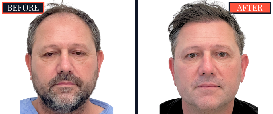2886 GRAFT FUT HAIR TRANSPLANT RESULT
