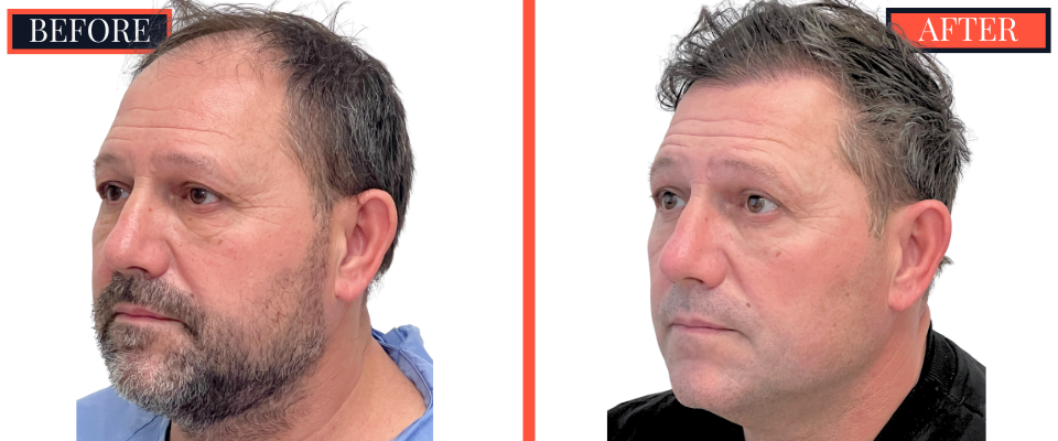 2886 GRAFT FUT HAIR TRANSPLANT RESULT