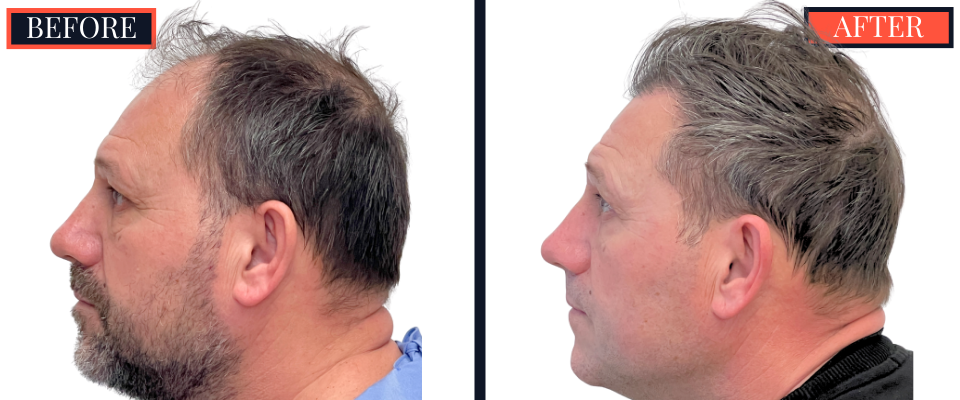2886 GRAFT FUT HAIR TRANSPLANT RESULT