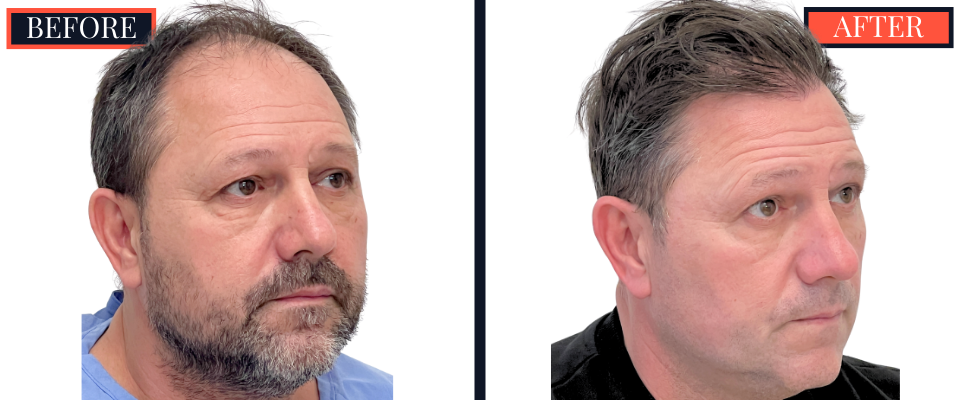 2886 GRAFT FUT HAIR TRANSPLANT RESULT
