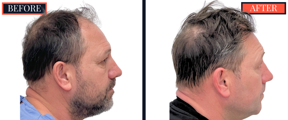 2886 GRAFT FUT HAIR TRANSPLANT RESULT