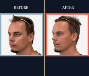 1570 Graft FUE HAIR TRANSPLANT BEFORE AND AFTER RESULT