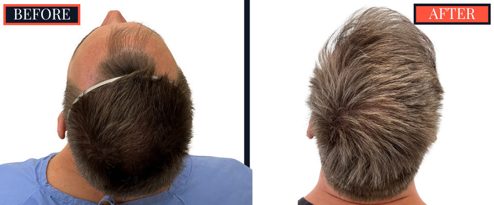 1570 Graft FUE HAIR TRANSPLANT BEFORE AND AFTER RESULT