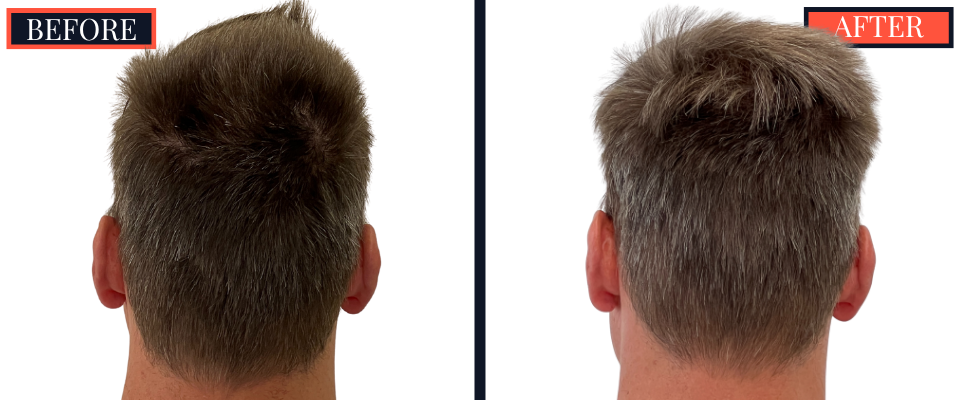 1570 Graft FUE HAIR TRANSPLANT BEFORE AND AFTER RESULT