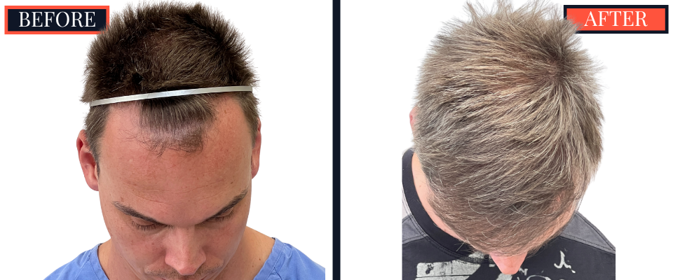 1570 Graft FUE HAIR TRANSPLANT BEFORE AND AFTER RESULT