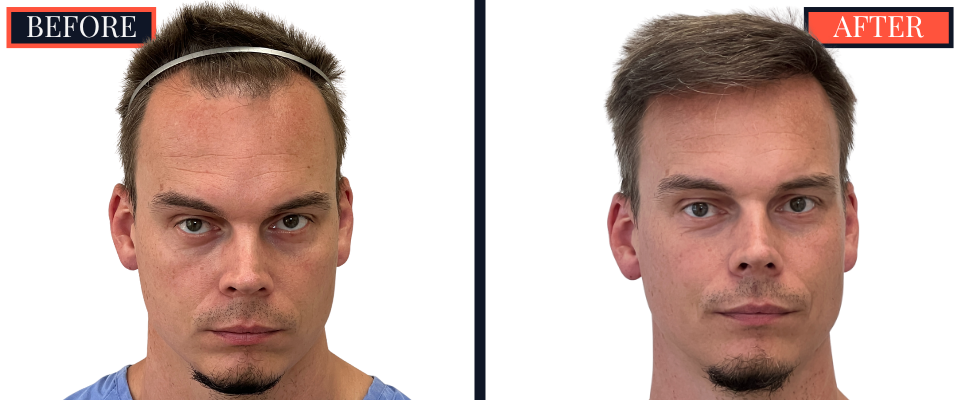1570 Graft FUE HAIR TRANSPLANT BEFORE AND AFTER RESULT