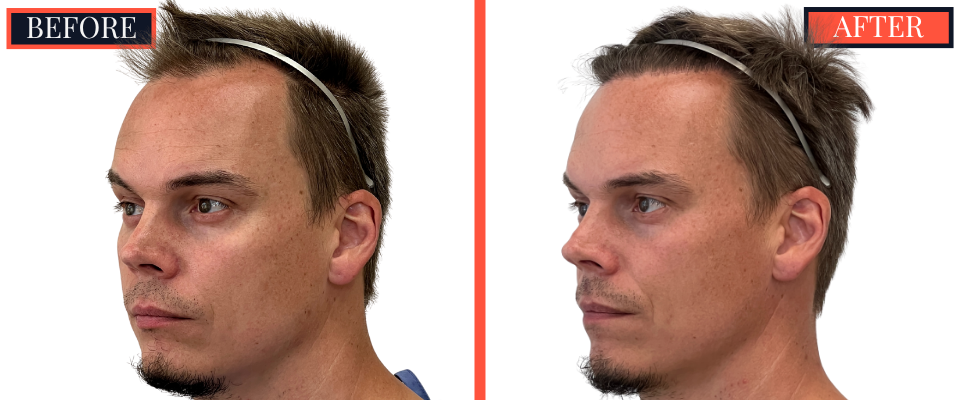 1570 Graft FUE HAIR TRANSPLANT BEFORE AND AFTER RESULT