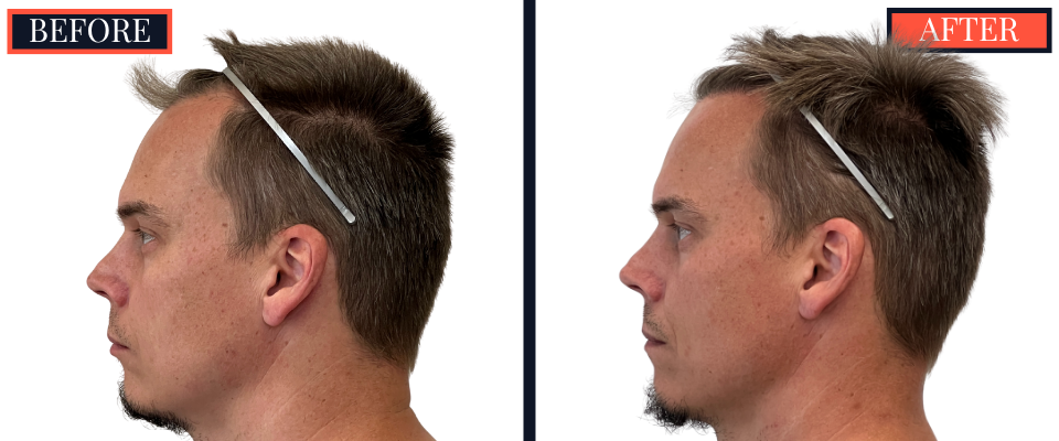 1570 Graft FUE HAIR TRANSPLANT BEFORE AND AFTER RESULT