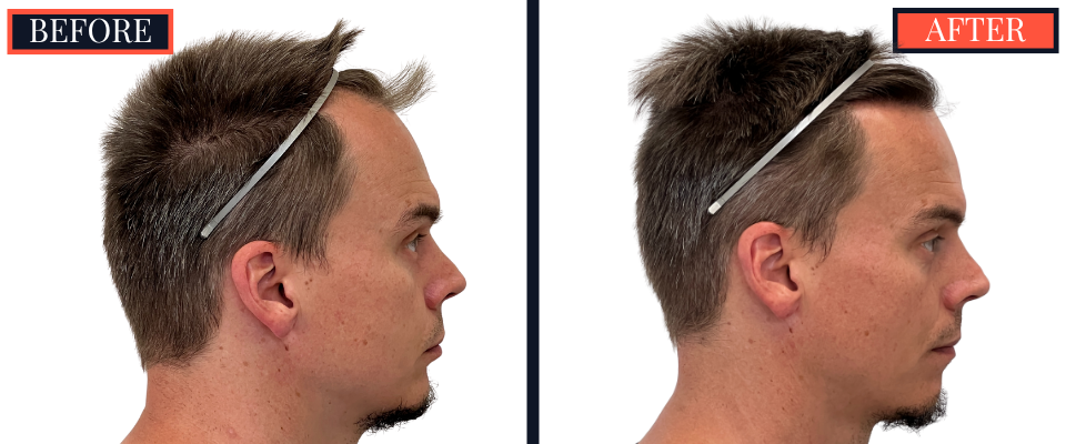 1570 Graft FUE HAIR TRANSPLANT BEFORE AND AFTER RESULT