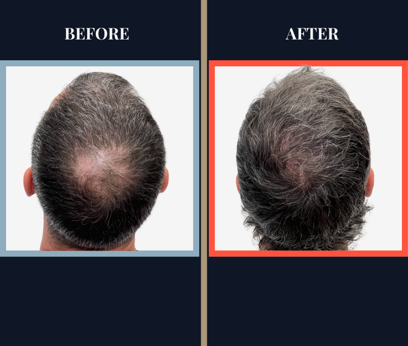 1210 graft FUE hair transplant before and after