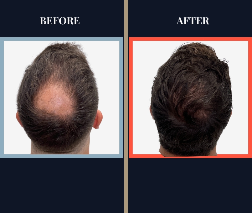 2078 graft FUE hair transplant before and after