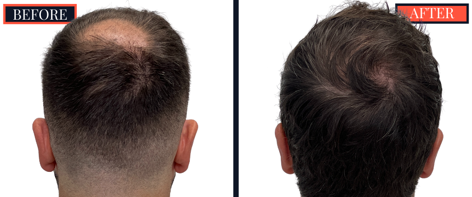 2078 graft FUE hair transplant before and after