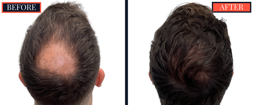 2078 graft FUE hair transplant before and after