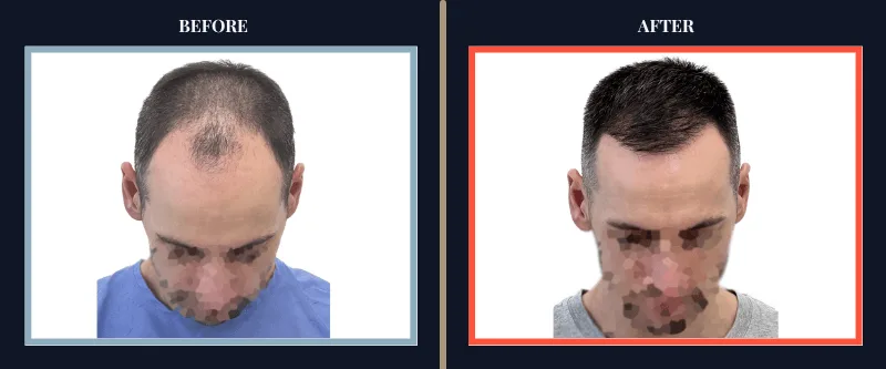 Hair Transplant Before & After Results