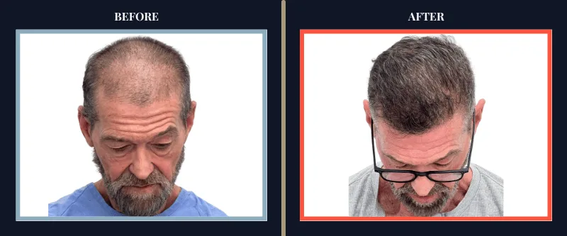 Hair Transplant Before & After Results
