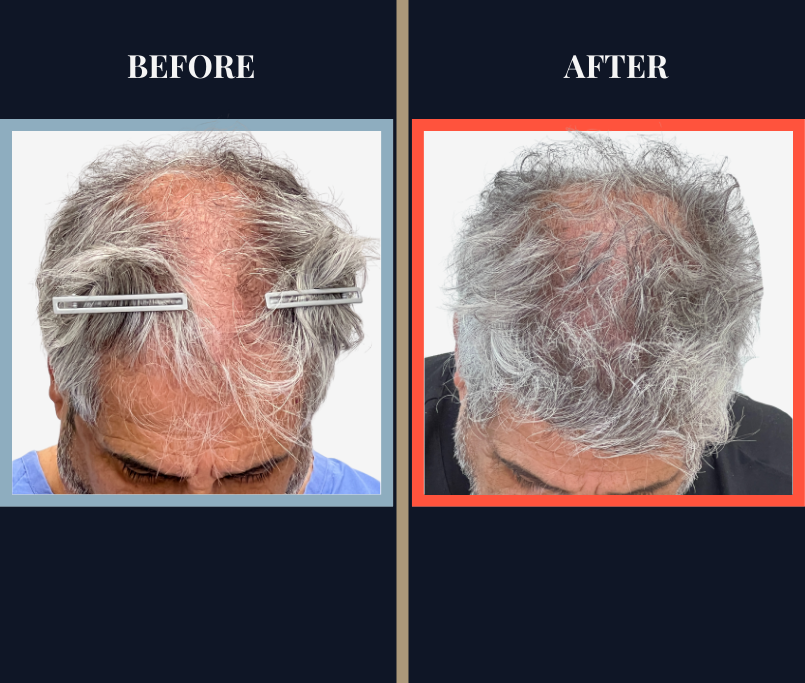 2526 GRAFT FUE HAIR TRANSPLANT - BEFORE AND AFTER