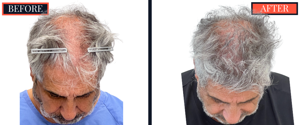 2526 GRAFT FUE HAIR TRANSPLANT - BEFORE AND AFTER