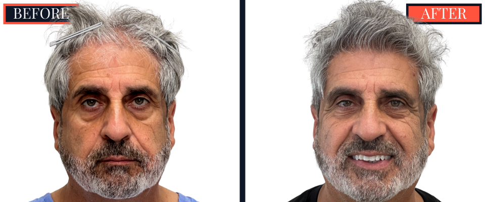 2526 GRAFT FUE HAIR TRANSPLANT - BEFORE AND AFTER