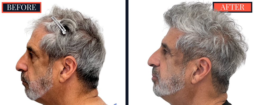 2526 GRAFT FUE HAIR TRANSPLANT - BEFORE AND AFTER