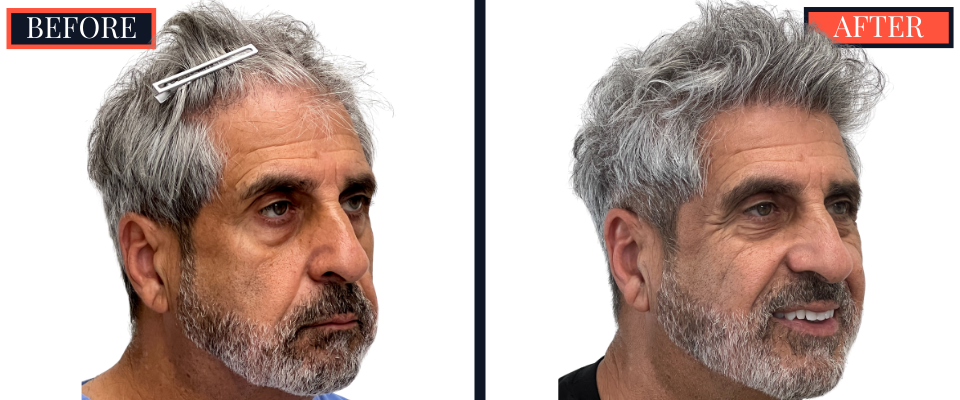 2526 GRAFT FUE HAIR TRANSPLANT - BEFORE AND AFTER