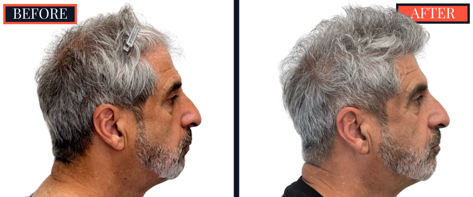 2526 GRAFT FUE HAIR TRANSPLANT - BEFORE AND AFTER