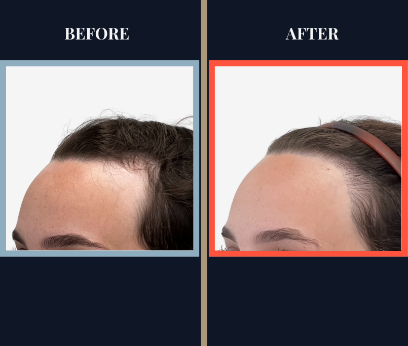 BEFORE AND AFTER - 1745 GRAFT FUT HAIR TRANSPLANT