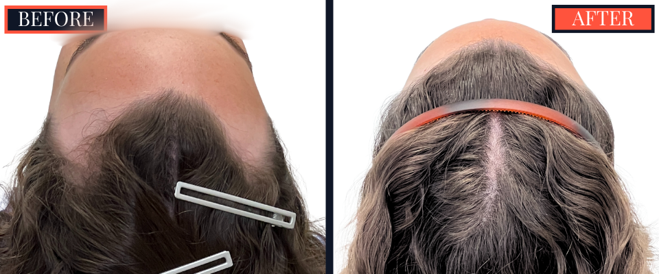 BEFORE AND AFTER - 1745 GRAFT FUT HAIR TRANSPLANT