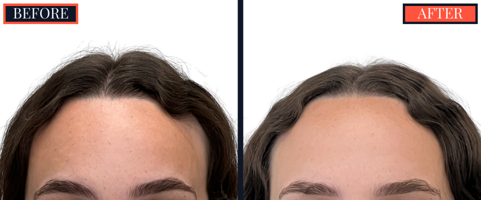 BEFORE AND AFTER - 1745 GRAFT FUT HAIR TRANSPLANT