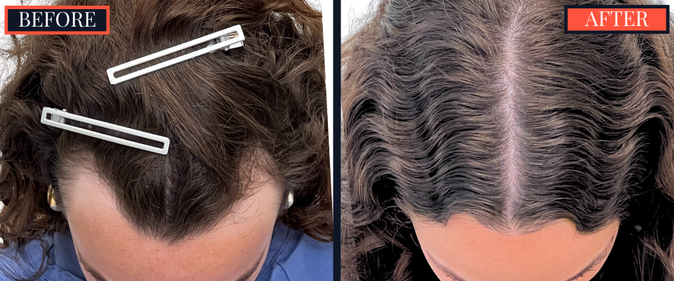 BEFORE AND AFTER - 1745 GRAFT FUT HAIR TRANSPLANT