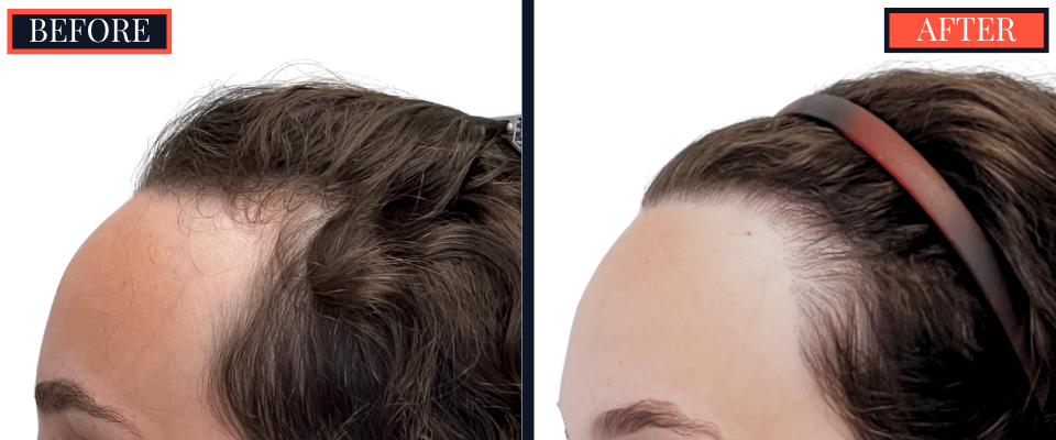 BEFORE AND AFTER - 1745 GRAFT FUT HAIR TRANSPLANT
