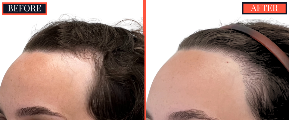 BEFORE AND AFTER - 1745 GRAFT FUT HAIR TRANSPLANT