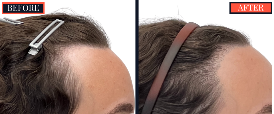 BEFORE AND AFTER - 1745 GRAFT FUT HAIR TRANSPLANT