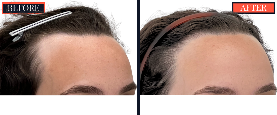BEFORE AND AFTER - 1745 GRAFT FUT HAIR TRANSPLANT
