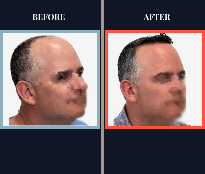 3020 GRAFT FUE HAIR TRANSPLANT RESULTS