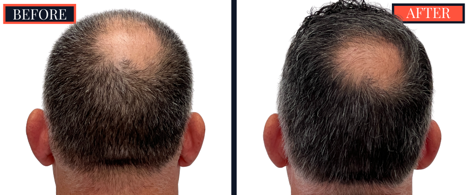 3020 GRAFT FUE HAIR TRANSPLANT RESULTS