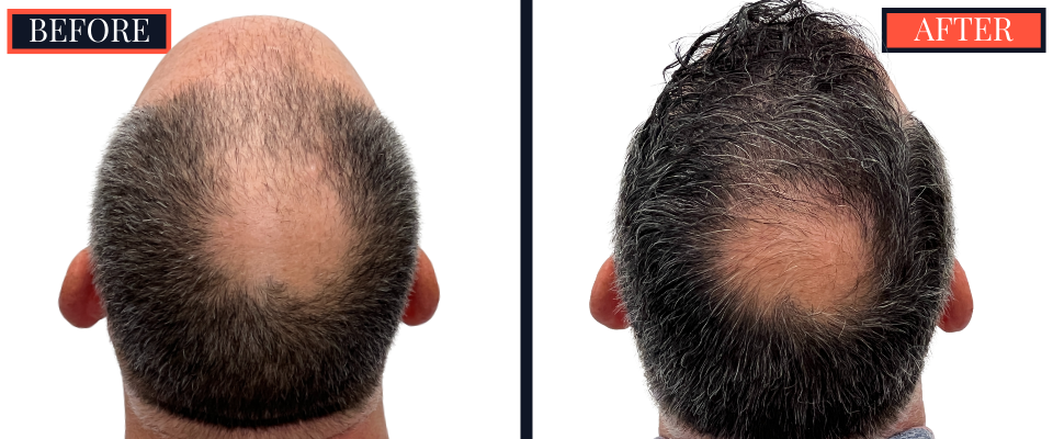 3020 GRAFT FUE HAIR TRANSPLANT RESULTS
