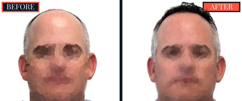 3020 GRAFT FUE HAIR TRANSPLANT RESULTS