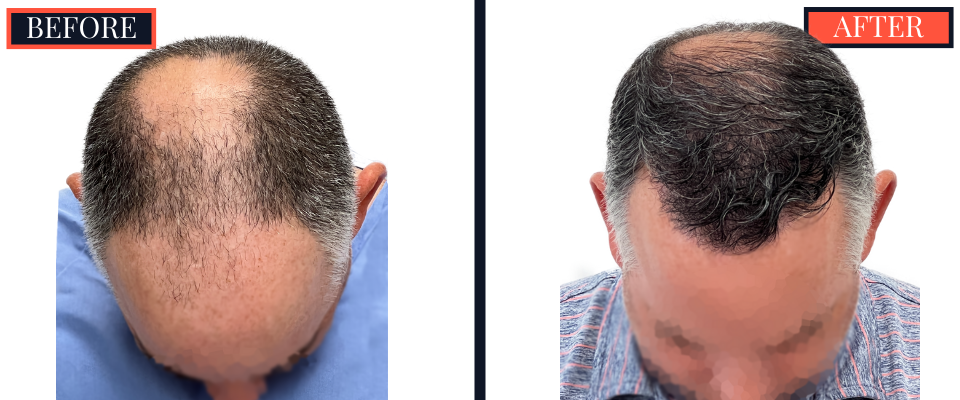 3020 GRAFT FUE HAIR TRANSPLANT RESULTS