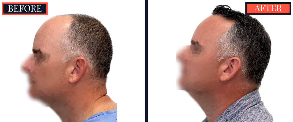 3020 GRAFT FUE HAIR TRANSPLANT RESULTS