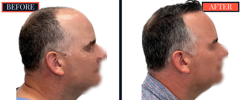 3020 GRAFT FUE HAIR TRANSPLANT RESULTS