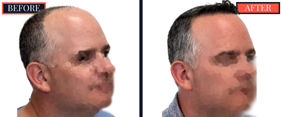 3020 GRAFT FUE HAIR TRANSPLANT RESULTS